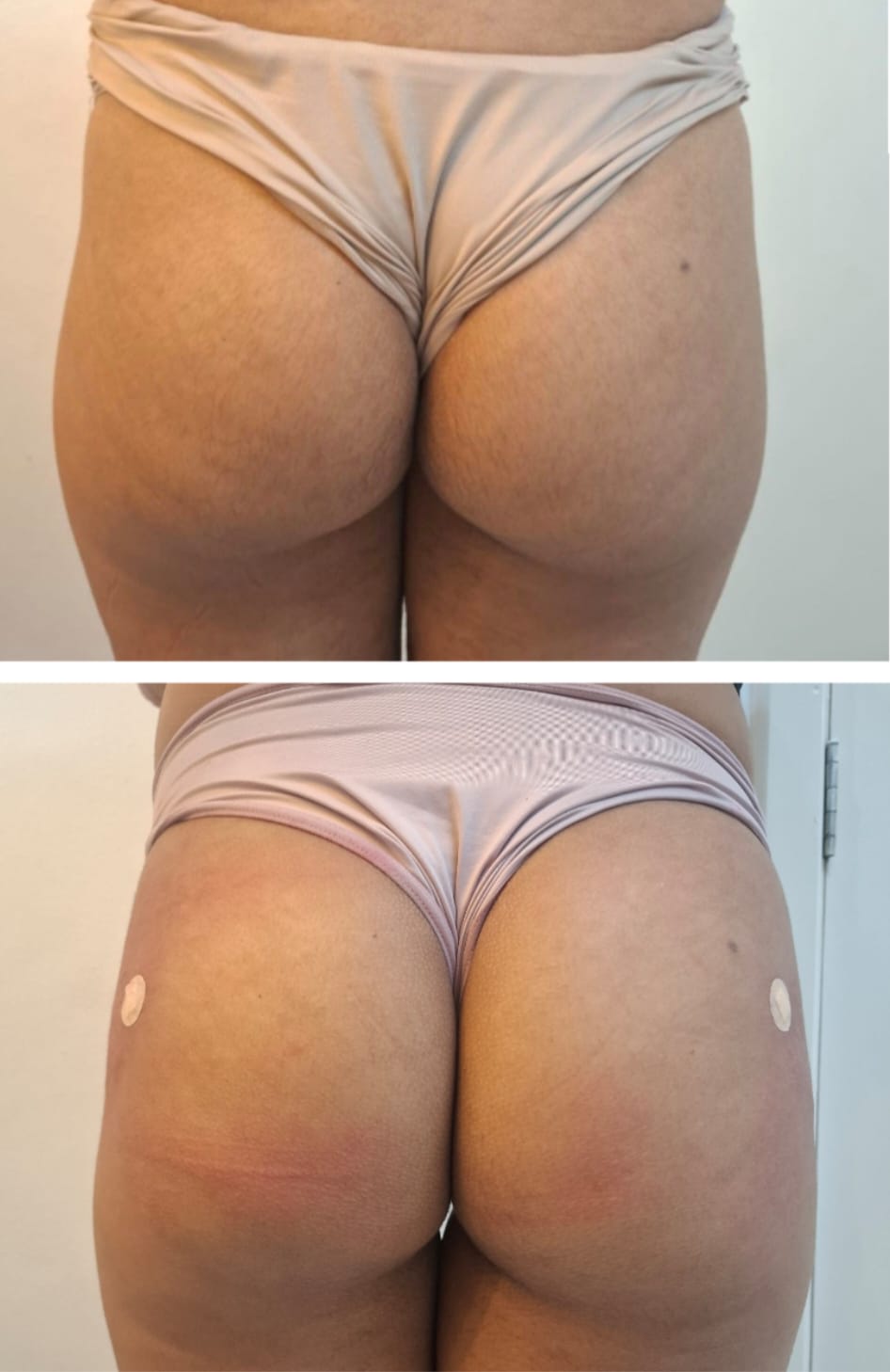 Antes e depois — Harmonização Glútea