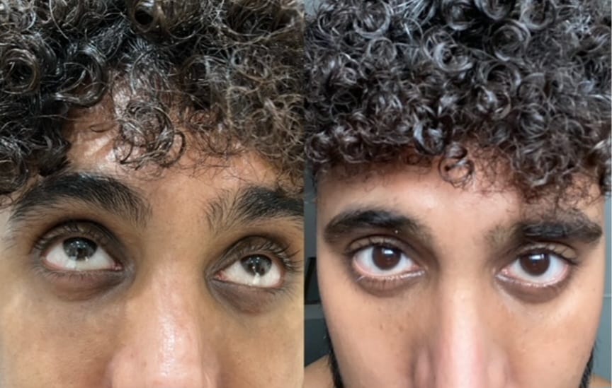 Antes e depois — Camuflagem de Olheiras