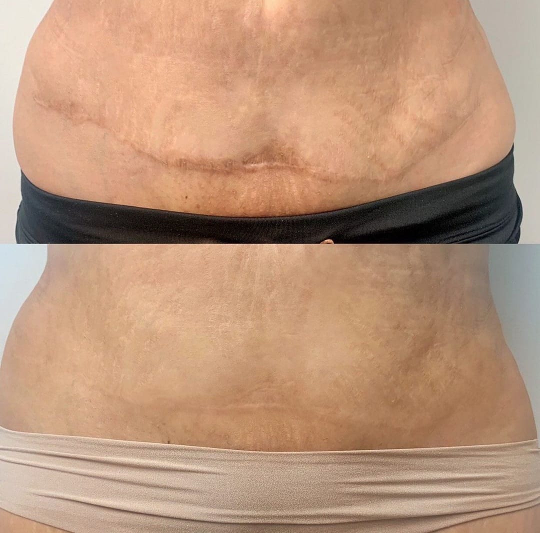 Antes e depois — Camuflagem de Cicatriz