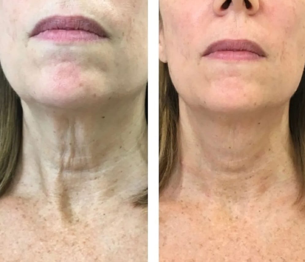 Antes e depois — Bioestimulador