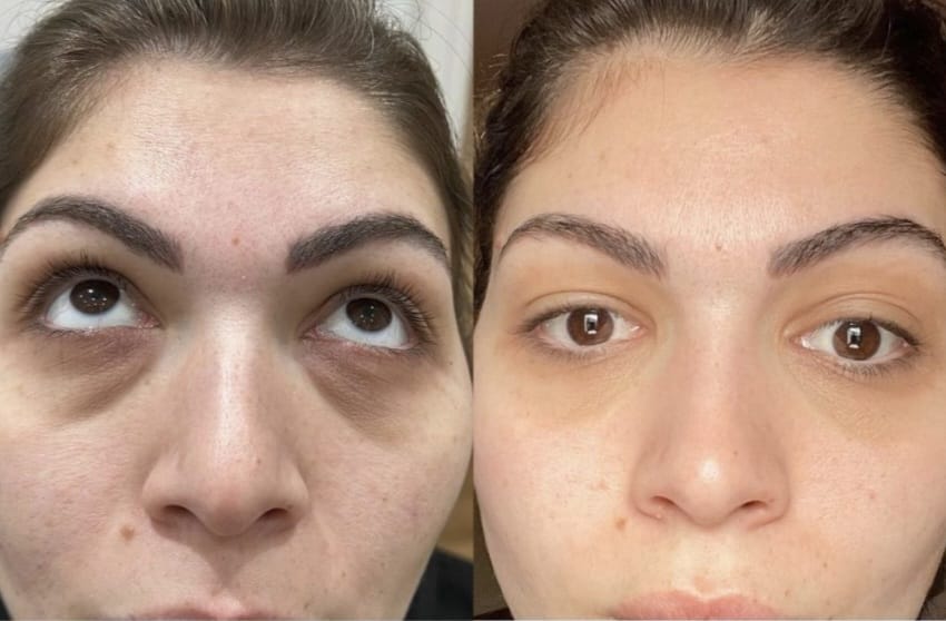Antes e depois — Camuflagem de Olheiras