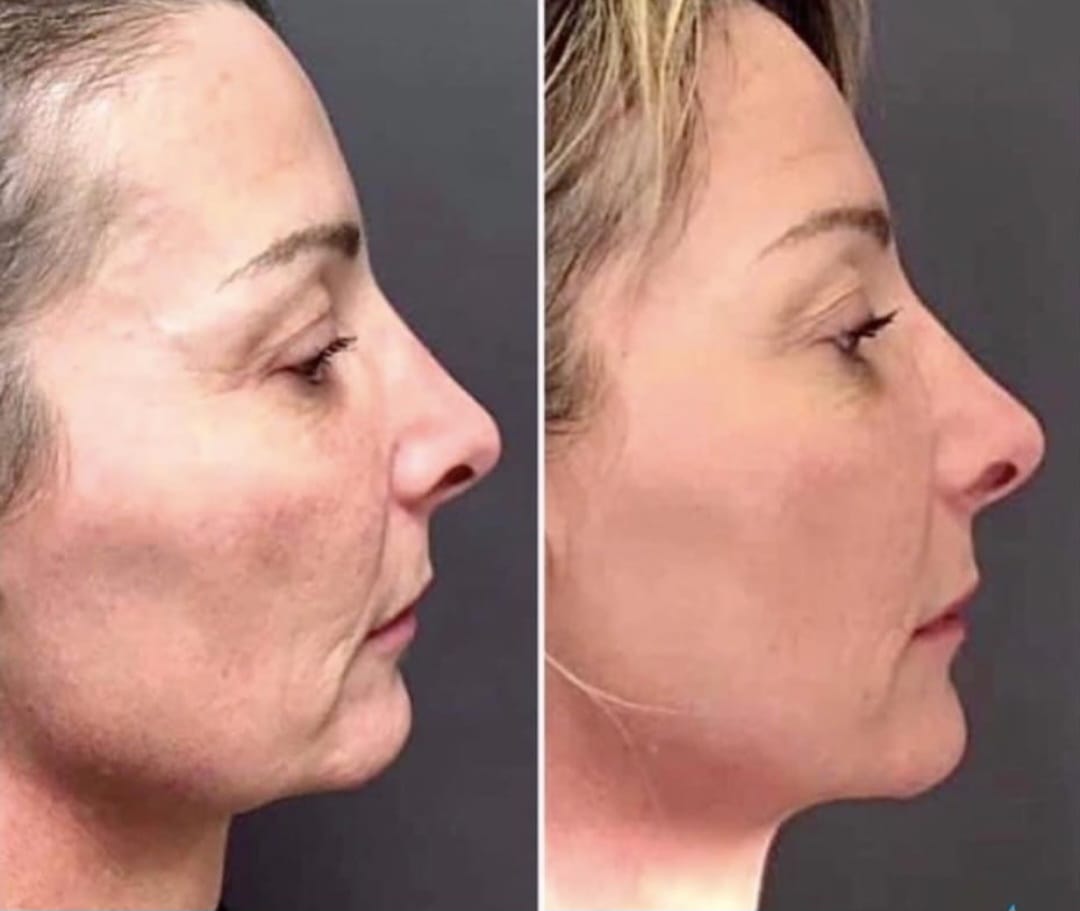 Antes e depois — Bioestimulador