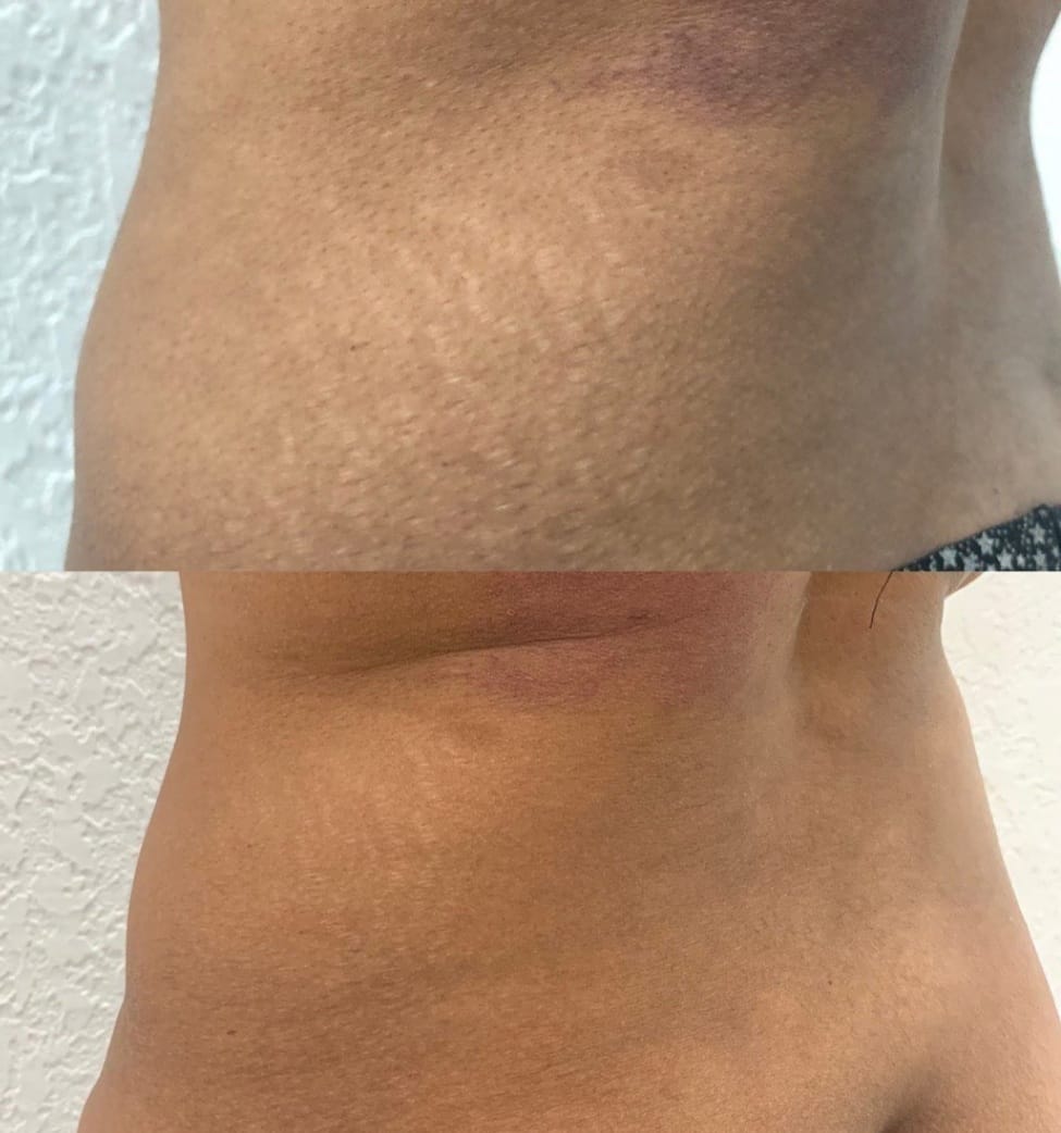 Antes e depois — Camuflagem de Estrias