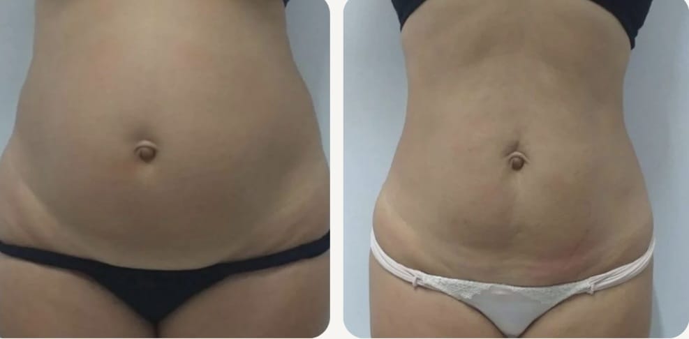 Antes e depois — Estética Corporal