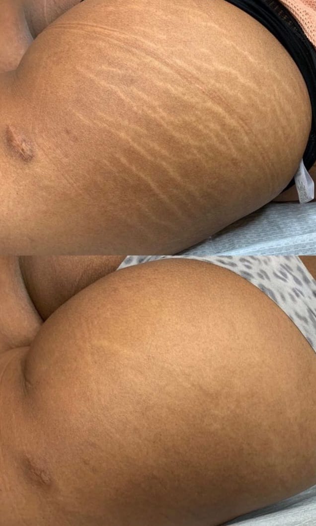 Antes e depois — Camuflagem de Estrias