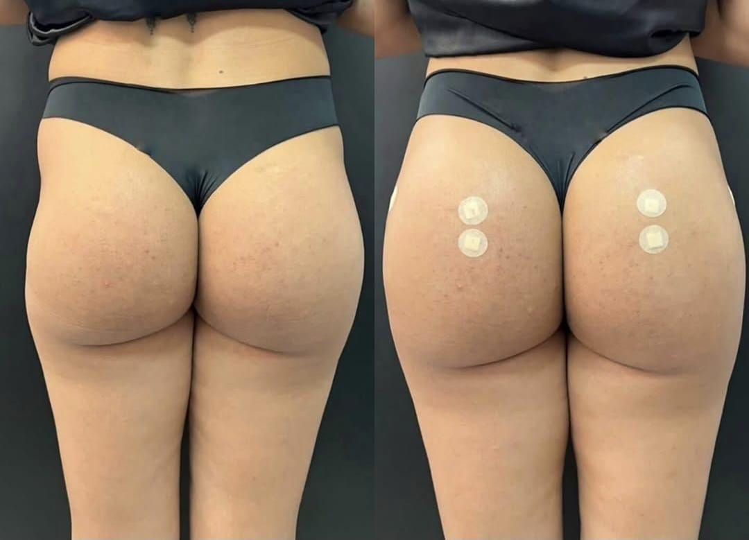 Antes e depois — Harmonização Glútea