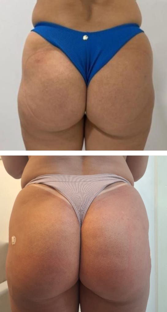Antes e depois — Harmonização Glútea