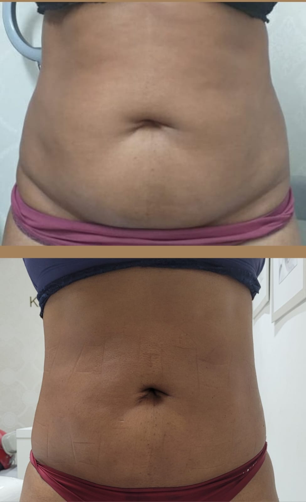 Antes e depois — Estética Corporal