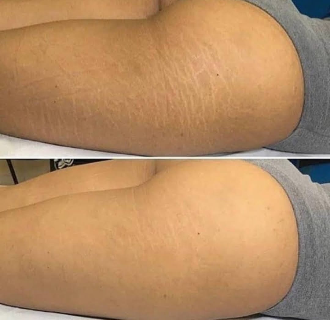 Antes e depois — Camuflagem de Estrias