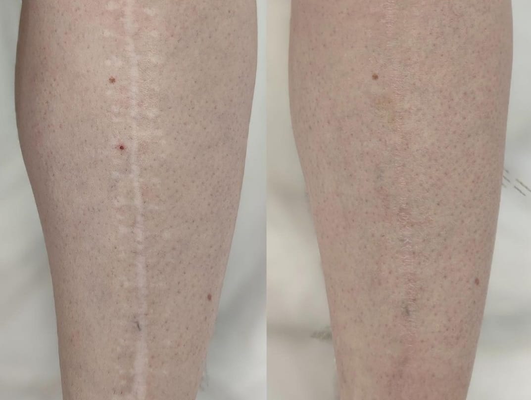 Antes e depois — Camuflagem de Cicatriz